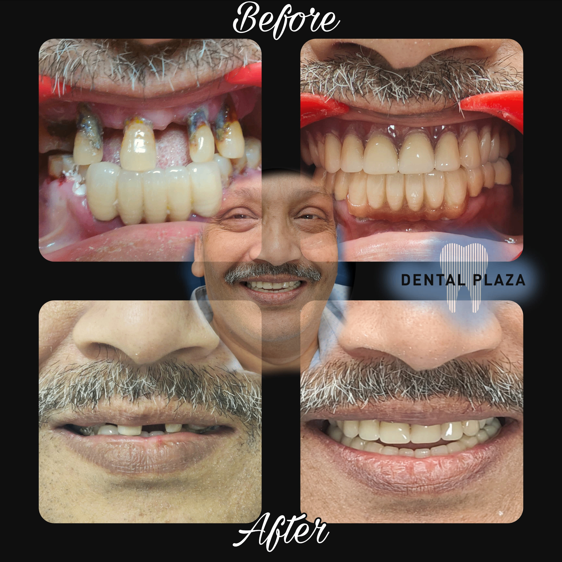 Full Mouth Rehabilitation