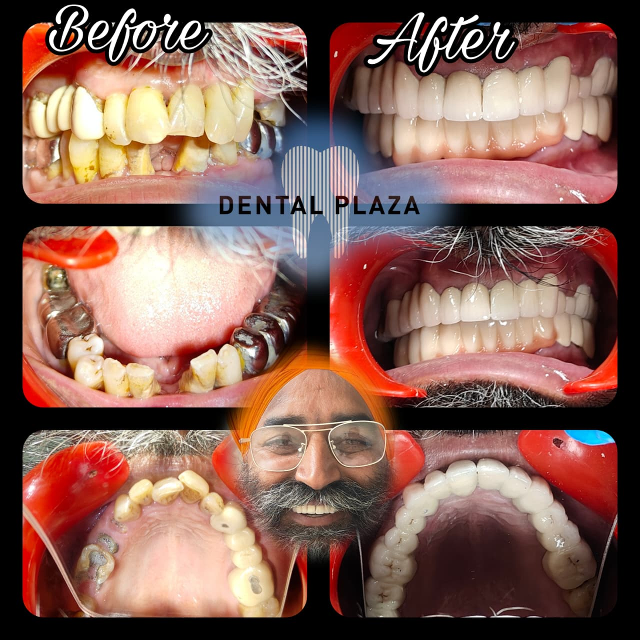 Complete Smile Makeover