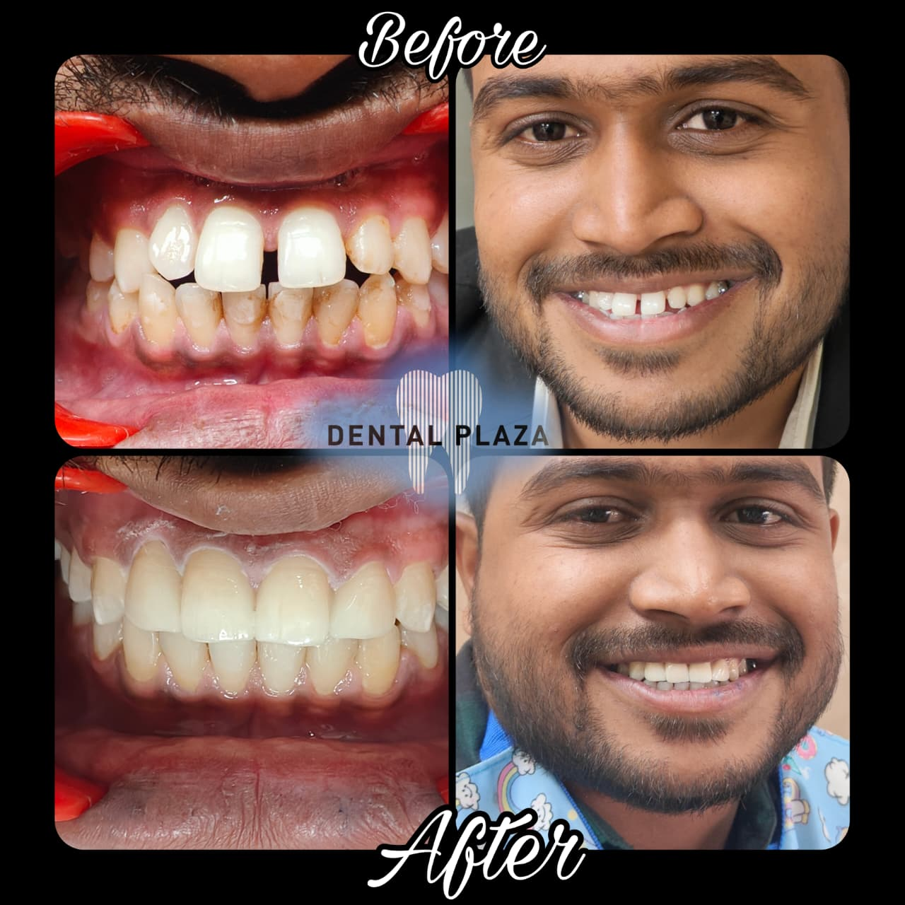 Cosmetic Smile Correction